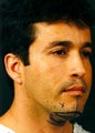 Chin Implant