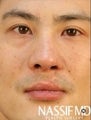 Asian Revision Rhinoplasty 