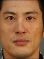 Asian Revision Rhinoplasty 
