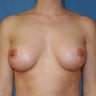 Breast Implants Augmentation Enlargement Enhancement 