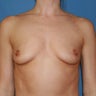 Breast Implants Augmentation Enlargement Enhancement 