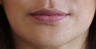 Lip Implants