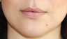 Lip Implants