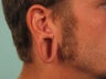 Ear Lobe Reconstruction 