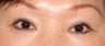 Asian Double Eyelid Surgery before and after