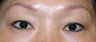Asian Double Eyelid Surgery before and after