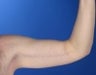 36 year old male weight loss patient with arm laxity