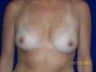 Breast Augmentation