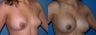 Breast Implant Revision