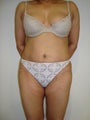 Mini Tummy Tuck