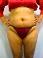 Mini Tummy Tuck