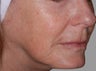 Exilis