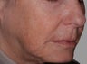 Exilis