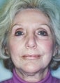 60 year old female patient 