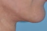 51 year old female who underwent a mini-facelift (min-lift)