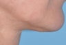 51 year old female who underwent a mini-facelift (min-lift)