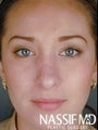 Female Revision Rhinoplasty 