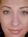 Female Revision Rhinoplasty 