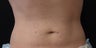 Coolsculpting Male
