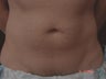 Coolsculpting Male