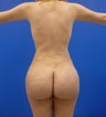 Brazilian Butt lift
