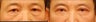 Male Upper and Lower Eyelid Surgery