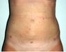 Liposuction