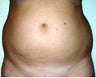 Liposuction