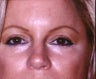 Blepharoplasty