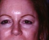 Blepharoplasty