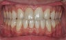 Maxillary Advancement and Canine Substitution