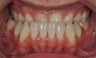 Maxillary Advancement and Canine Substitution