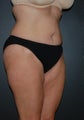 Tummy Tuck