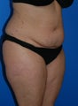 Tummy Tuck