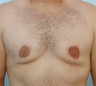 Male Breast Reduction