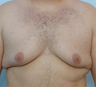 Male Breast Reduction