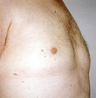 Male Breast Reduction