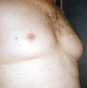 Male Breast Reduction