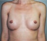 Breast Augmentation