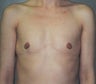 Breast Augmentation