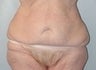 Female patient who underwent a body lift, and brachioplasty 