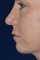 Chin Implant, Rhinoplasty and Signature Facelift
