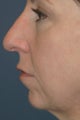 Chin Implant, Rhinoplasty and Signature Facelift