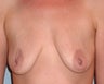 Breast Implants for Self-Conscious Woman