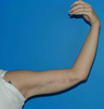 Arm Lift