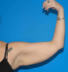 Arm Lift