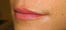 Lip Augmentation