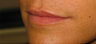 Lip Augmentation
