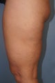 43 year old treated with Cellulaze of thighs