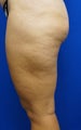 43 year old treated with Cellulaze of thighs